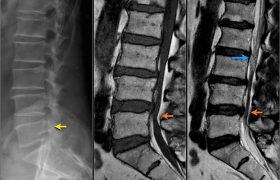 Поясничный стеноз позвоночного канала: причины, диагностика, лечение, осложнения