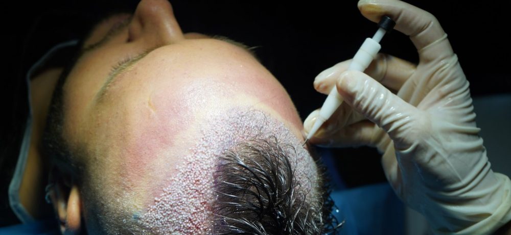 Современная пересадка волос: разница между FUE и DHI