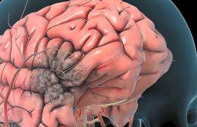 Эндоваскулярное лечение инсульта: как быстро улучшается состояние?