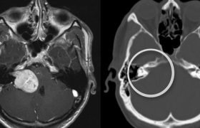 Невринома слухового нерва