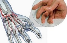 Ревматоидный артрит пальцев рук: 6 первых симптомов