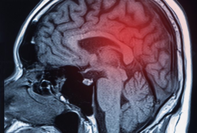 Факторы риска эпилепсии при абсцессе головного мозга