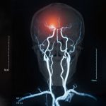 Эритропоэтин в лечении неврита зрительного нерва ПУБЛИКАЦИИ Эритропоэтин в лечении неврита зрительного нерва 24 декабря 2021 Актуальность Нередко неврит зрительного нерва является первым симптомом рассеянного склероза. Так, у около одной пятой всех больных с невритом зрительного нерва в течение первых двух лет с момента его диагностики выявляется рассеянный склероз. Сегодня для лечения неврита зрительного нерва используются в/в глюкокортикоиды в высоких дозах (метилпреднизолон), однако их назначение не сопровождается улучшением отдаленных исходов таких пациентов. Целью обсуждающегося исследования была оценка эффективности и безопасности эритропоэтина у пациентов с невритом зрительного нерва.  Методы Рандомизированное плацебо контролируемое двойное слепое исследование проводилось в 12 центрах в Германии. Включались пациенты с невритом зрительного нерва (продолжительность менее 10 дней), не имеющие диагноза рассеянного склероза. Участники рандомизировались в две группы: плацебо и эритропоэтина. Первичной конечной точкой была выраженность атрофии папиллярного слоя нервных волокон сетчатки.  Результаты  За период с ноября 2014 по октябрь 2017 в исследование было включено 108 пациентов (55 рандомизированы в группу эритропоэтина, а 53 – в группу плацебо).  Продолжительность лечения составляла 26 недель. К концу этого периода не было выявлено значимых различий в выраженности атрофии папиллярного слоя нервных волокон сетчатки между группами эритропоэтина и плацебо (скорректированная разница средних 1.02 мкм; 95% доверительный интервал -5.51-7.55; p=0.76).  Наиболее частым нежелательным явлением была головная боль (у 28% пациентов в группе эритропоэтина и у 25% пациентов в группе плацебо).  Заключение Таким образом, терапия эритропоэтином не улучшает исходы пациентов с невритом зрительного нерва.