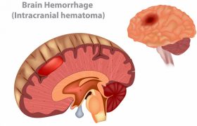 TRIAGE: новые данные о транексамовой кислоте при геморрагическом инсульте