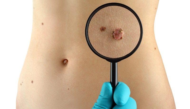 Как вовремя распознать признаки рака?