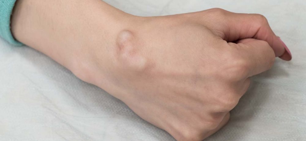 Как предотвратить появление атеромы