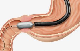 Что такое бужирование и когда его назначают