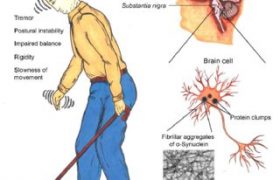 Врач назвал неочевидные ранние признаки болезни Паркинсона
