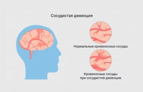 Ранние сигналы. Названы пять признаков деменции, не связанных с памятью