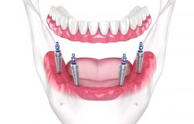 Протезирования зубов на имплантах All-on-4 недорого в Туле