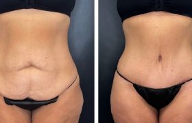 Популярные пластические операции: восстановление формы и уверенности