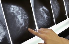 Маммография: современный подход к ранней диагностике рака молочной железы