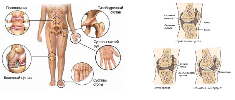 Ревматоидный артрит: симптомы, диагностика и лечение