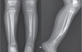 Что такое ложный сустав?