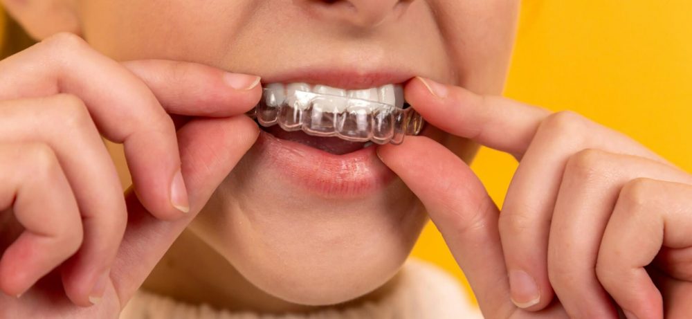 Когда стоит задуматься об элайнерах: признаки, которые нельзя игнорировать