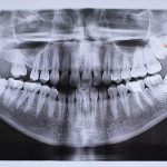 Аутотрансплантация зуба: когда пересадка собственного зуба становится лучшим решением