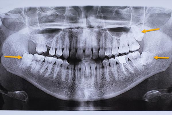 Аутотрансплантация зуба: когда пересадка собственного зуба становится лучшим решением