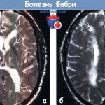 Болезнь Фабри