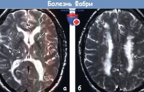 Болезнь Фабри